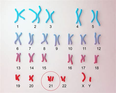 Trisomy 21 Down Syndrome - Down Syndrome (Trisomy 21) : A child with ...