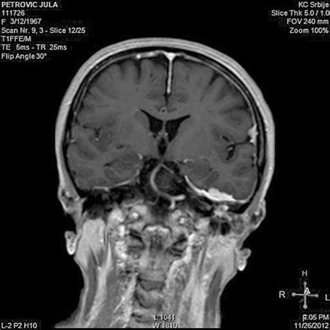 Attic Cholesteatoma For Illustrative Purposes Only Not Taken From A