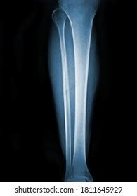 Xray Normal Human Tibia Lateral View Stock Photo 1811645929 Shutterstock