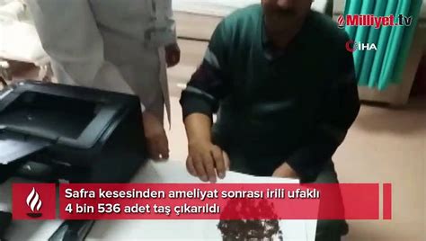 Doktor Bile Oke Oldu Safra Kesesinden Bin Ta Kt