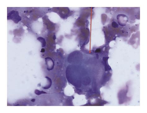 Bone Marrow Aspirate Smear Dysplastic Megakaryocytes 100x