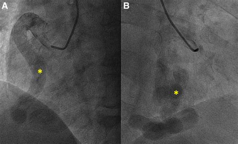 Mimic Of Atrial Septal Defect Circulation Cardiovascular Imaging