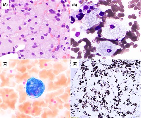 A Bone Marrow Clot Hematoxylin And Eosin Stain B Bone Marrow