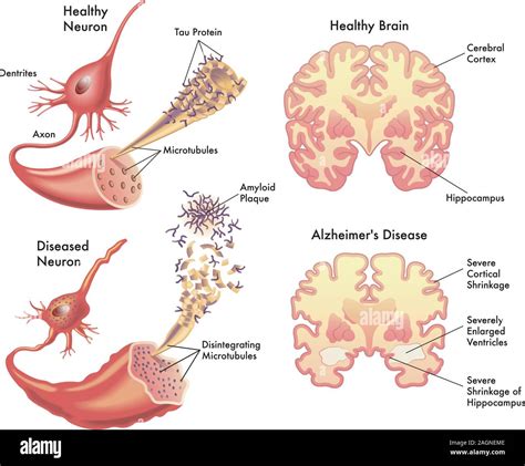 Depressione Del Sistema Nervoso Centrale Immagini E Fotografie Stock Ad