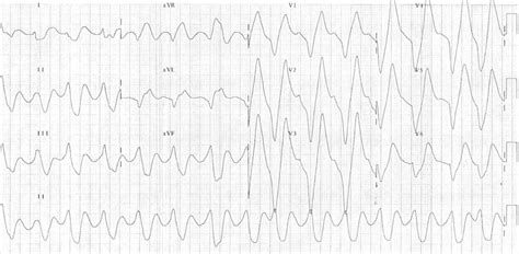 Sine Wave Hyperkalemia Ecg Changes