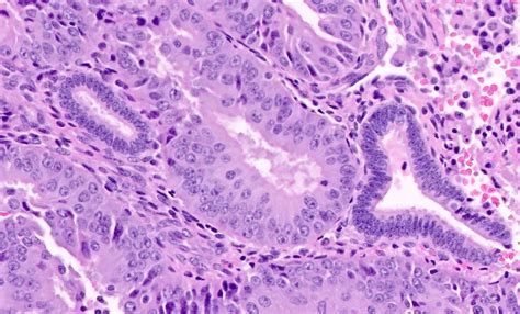 Pathology Outlines Endometrial Hyperplasia