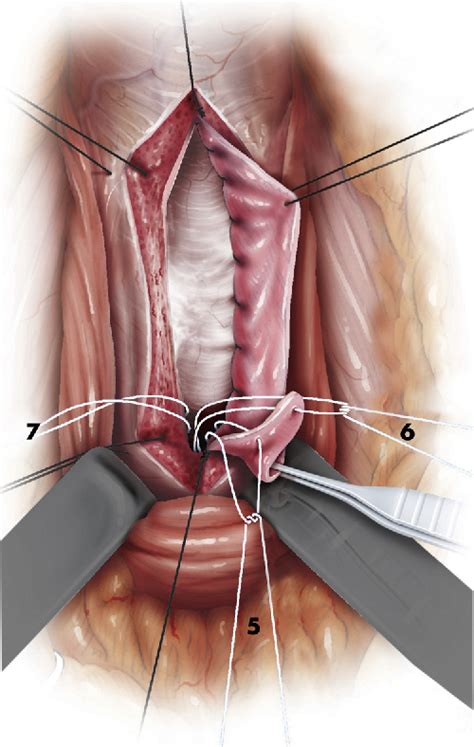 Figure From Ventral Oral Mucosal Onlay Graft Urethroplasty In