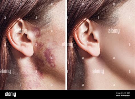 Closeup Of Before And After Treatment Woman Face With Real Port Wine