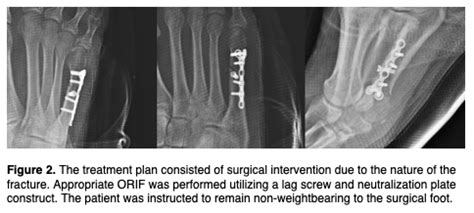 Reconstructive Surgical Option For A Comminuted Fifth Metatarsal