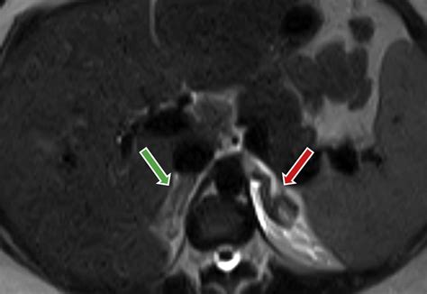 Acute Unilateral Nonhemorrhagic Adrenal Infarction In Pregnancy Aace