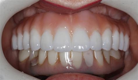 Full Archfull Mouth Implant Bridges With Pink Dental Implant Center