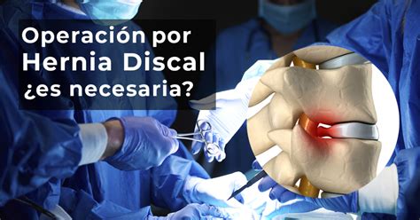 La Operaci N Por Hernia Discal Es Necesaria Cordus Colombia