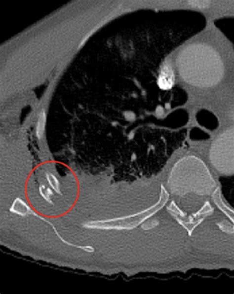 Rib Fracture Ct Scan