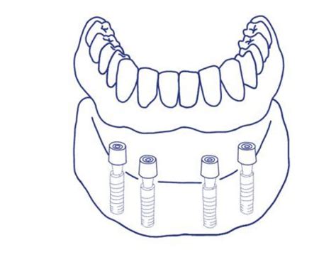 Qu Es Una Sobredentadura Sobre Implantes Cl Nica Dental M Laga