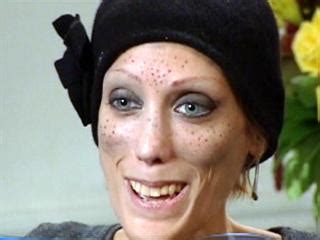 Isabelle Caro Photos: Isabelle Caro, Anorexic Model, Dies at 28 | Long Island Press