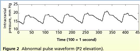 Figure 1 From Intracranial Pressure Waveform Morphology And