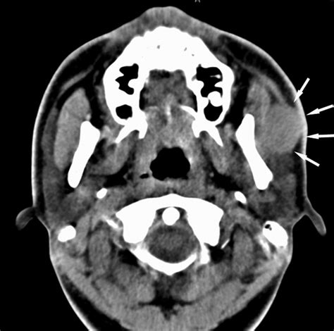 Diagnosis And Treatment Of Accessory Parotid Gland Tumors Journal Of Oral And Maxillofacial