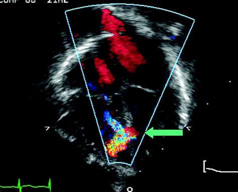 Ventricular Septal Defects Circulation