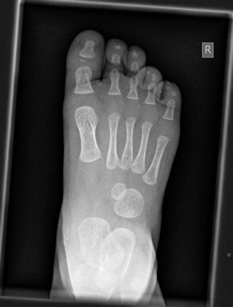 Normal Foot Xray Child