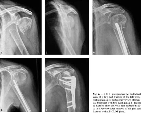 Proximal Humerus Fracture Orif