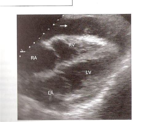 CVT Mohd Farid: Basic Echo Window :Subcostal View