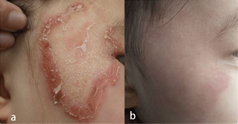 Clinical Appearance A Annular Plaque With Erythema Covered With Scales