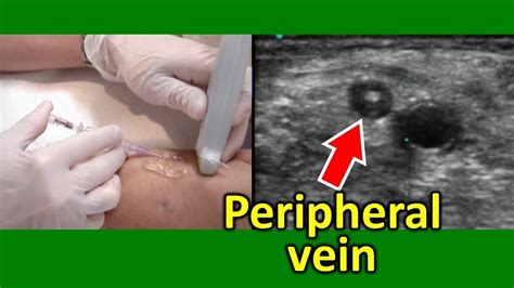 Ultrasound Guided Peripheral Venous Cannulation In An Actual Patient