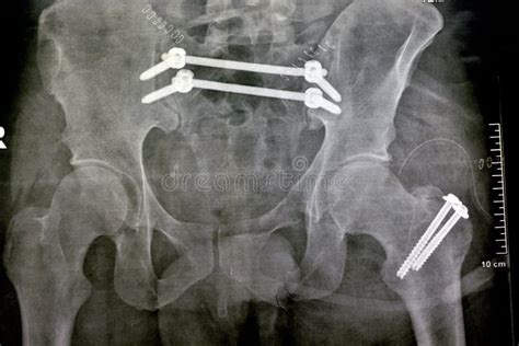 Fracture Of The Greater Trochanter Of Femur And Fracture Pelvis Fixed