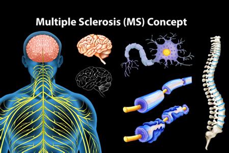 Causes-of-multiple-sclerosis – Physioline