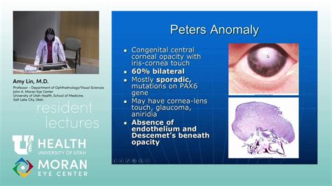 Peters Anomaly