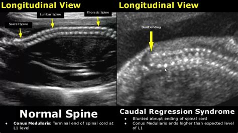 Conus Medullaris Ultrasound