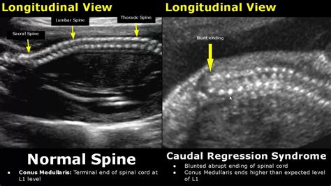 Conus Medullaris Ultrasound