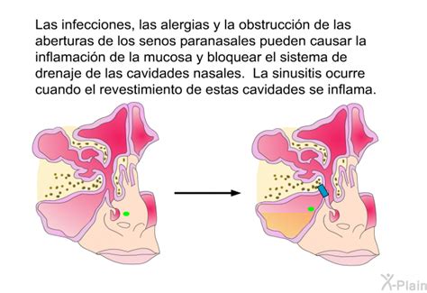 PatEdu Cirugía de los senos paranasales