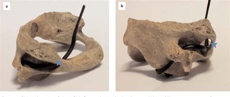 Figure 1 From Evaluation Of The Groove For Vertebral Artery Using Ct Angiography Semantic Scholar