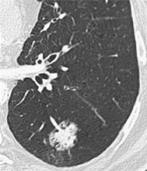 17 Mm Nodule Having Spiculated Margins And Located Within The Left Download Scientific Diagram