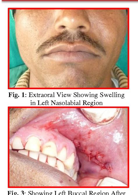 Figure 1 From Epidermoid Cyst Of The Buccal Mucosa A Case Report