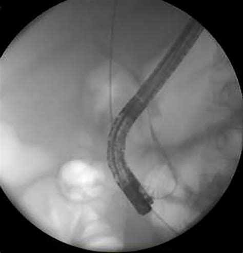 Id 3522367 Extraction Of Impacted Common Bile Duct Stone And Basket Complex Using Rescue