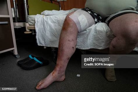 Landmine Injuries Photos Et Images De Collection Getty Images