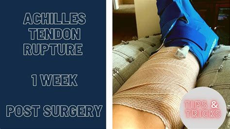 Achilles Tendon Rupture 1 Week POST SURGERY 2021 YouTube