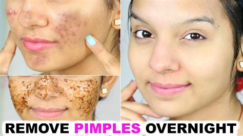 How To Remove Pimples Fast Naturally