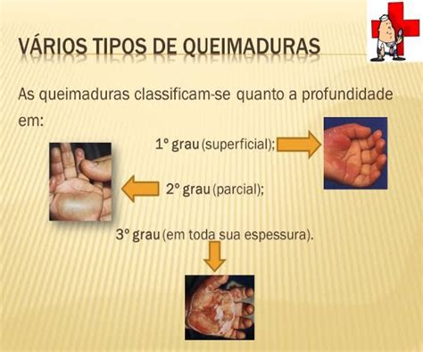 Queimadura Com Nitrogênio Líquido Librain