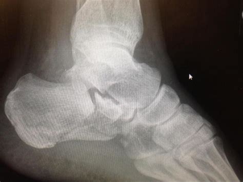 Figure Calcaneus Fracture Intra Articular Calcaneal With