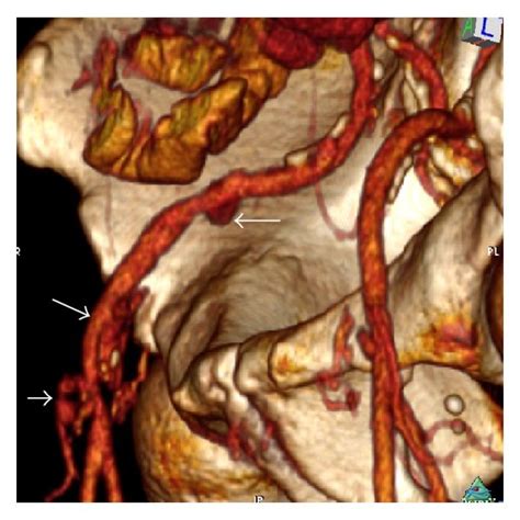 A Preoperative Computed Tomography Angiography Cta Reconstruction