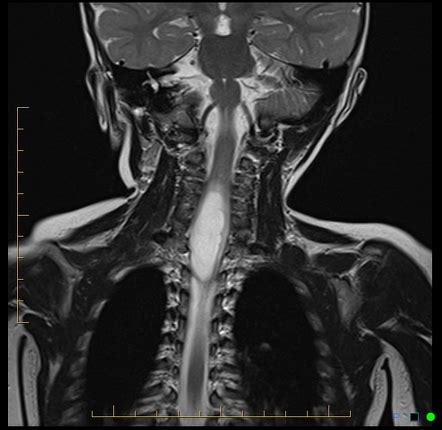 Spinal Pilocytic Astrocytoma Image Radiopaedia Org