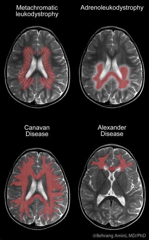 Metachromatic Leukodystrophy Mri