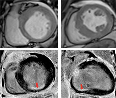 Contrast Enhanced Cardiovascular Magnetic Resonance Imaging Cine