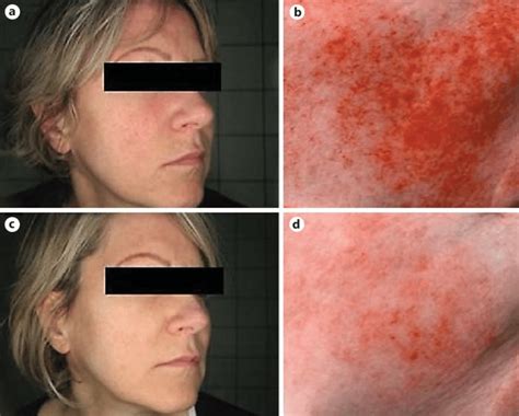 Patient With Erythrosis And Fine Telangiectasia Of The Cheeks Before Download Scientific