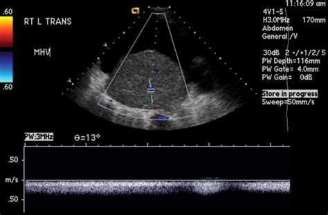 Understanding The Spectral Doppler Waveform Of The Hepatic Veins In