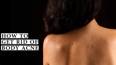 How To Get Rid Of Body Acne Youtube