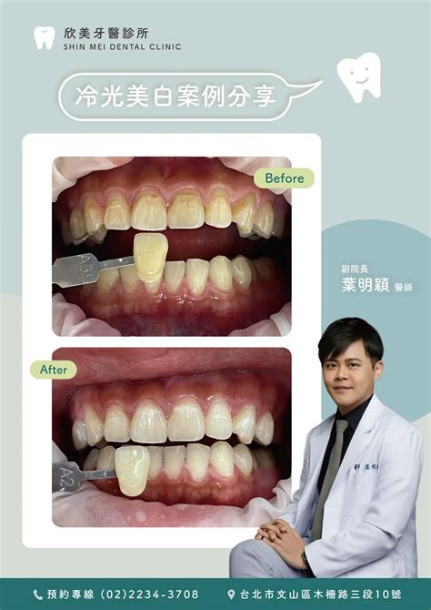 冷光美白案例 欣美牙醫｜shin Mei Dental Clinic